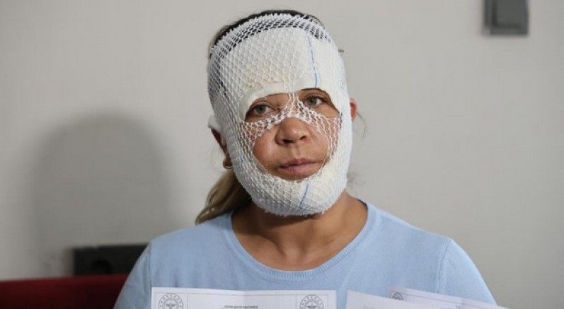 Güzelleşmek uğruna gittiği merkezde yüzü yandı