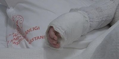 Bebeğin vücudunun yüzde 27'si yandı