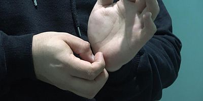 Son yılların korkulu rüyası: Uyuz