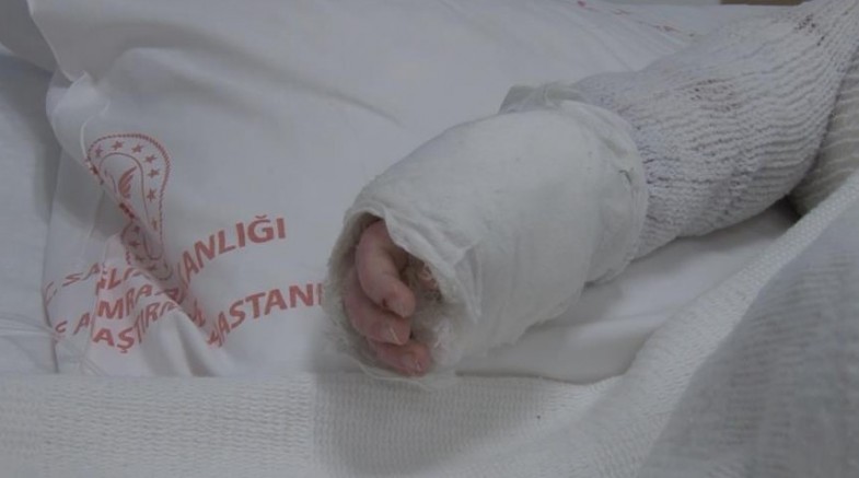 Bebeğin vücudunun yüzde 27'si yandı